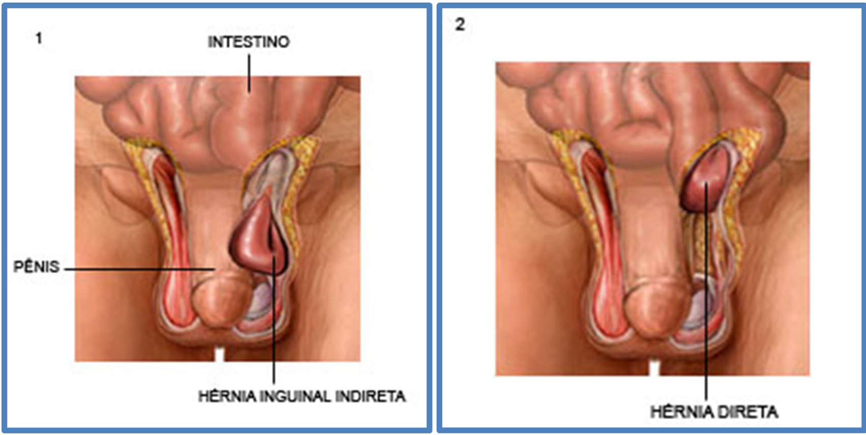 Conheça a hérnia inguinal, a mais comum no abdômen – SulMedical