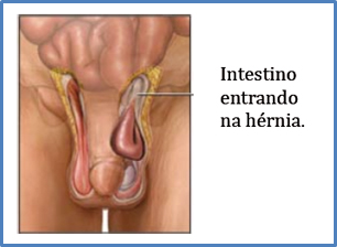 Rio Day Hospital - A hérnia inguinal é uma protuberância que surge na  virilha, especialmente em homens, que ocorre quando uma parte do intestino  sai através de um ponto fraco dos músculos